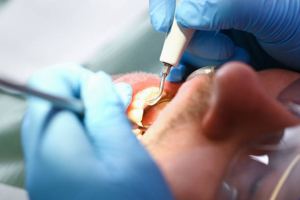 Best Emergency Wisdom Teeth Removal in Cranford, NJ